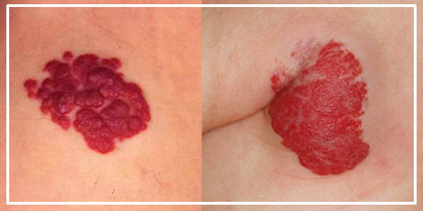 Удаление гемангиомы: лазером, скальпелем, криотерапией, электрофорезом, склеротерапией