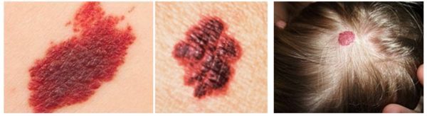 Удаление гемангиомы: лазером, скальпелем, криотерапией, электрофорезом, склеротерапией