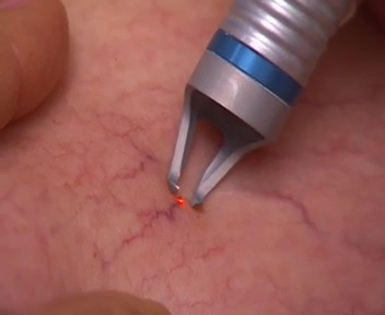 Удаление лазером сосудистых звездочек на лице: преимущества, противопоказания, подготовка к процедуре, восстановление и побочные эффекты