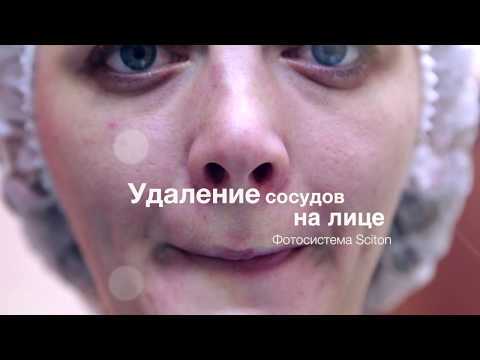 Удаление лазером сосудистых звездочек на лице: преимущества, противопоказания, подготовка к процедуре, восстановление и побочные эффекты