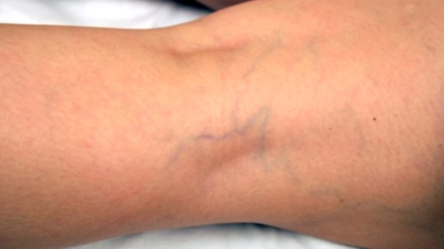 Удаление лазером сосудистых звездочек на лице: преимущества, противопоказания, подготовка к процедуре, восстановление и побочные эффекты