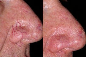 Удаление лазером сосудистых звездочек на лице: преимущества, противопоказания, подготовка к процедуре, восстановление и побочные эффекты