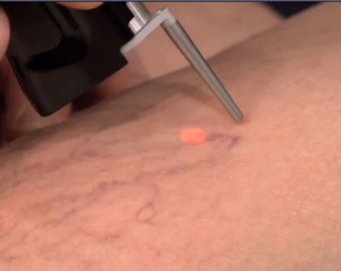 Удаление лазером сосудистых звездочек на лице: преимущества, противопоказания, подготовка к процедуре, восстановление и побочные эффекты