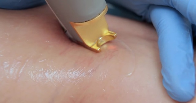 Удаление лазером сосудистых звездочек на лице: преимущества, противопоказания, подготовка к процедуре, восстановление и побочные эффекты