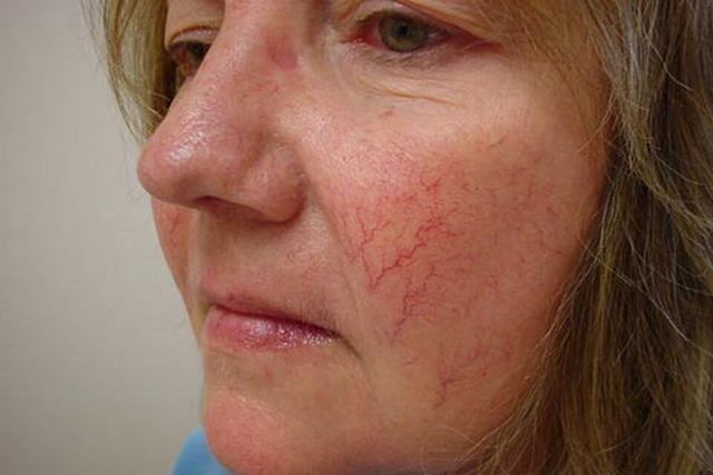 Удаление лазером сосудистых звездочек на лице: преимущества, противопоказания, подготовка к процедуре, восстановление и побочные эффекты