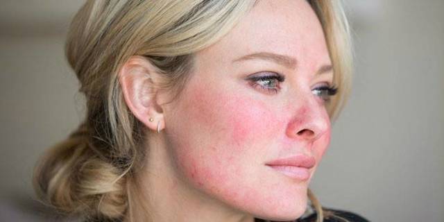 Удаление лазером сосудистых звездочек на лице: преимущества, противопоказания, подготовка к процедуре, восстановление и побочные эффекты