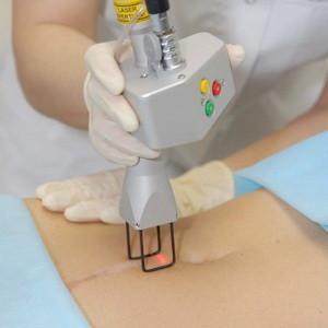 Удаление лазером сосудистых звездочек на лице: преимущества, противопоказания, подготовка к процедуре, восстановление и побочные эффекты