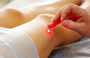 Удаление лазером сосудистых звездочек на лице: преимущества, противопоказания, подготовка к процедуре, восстановление и побочные эффекты