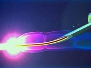 Удаление вен при варикозе на ногах: подготовка, виды, последствия