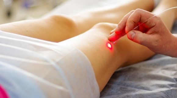Удаление вен при варикозе на ногах: подготовка, виды, последствия