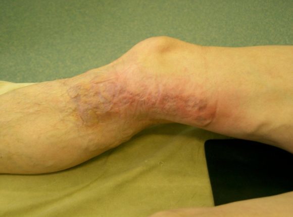 Удаление вен при варикозе на ногах: подготовка, виды, последствия