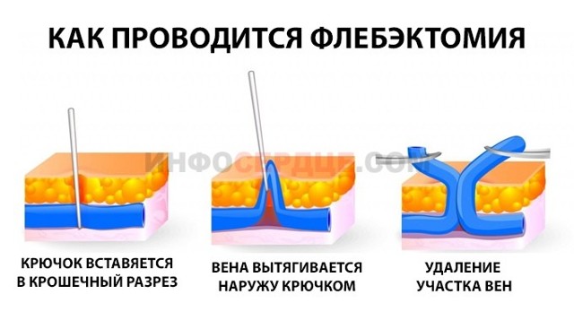 Удаление вен при варикозе на ногах: подготовка, виды, последствия