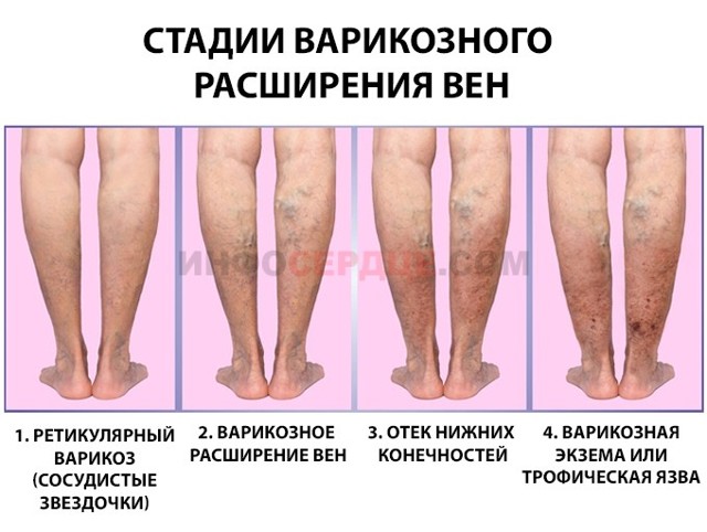 Удаление вен при варикозе на ногах: подготовка, виды, последствия