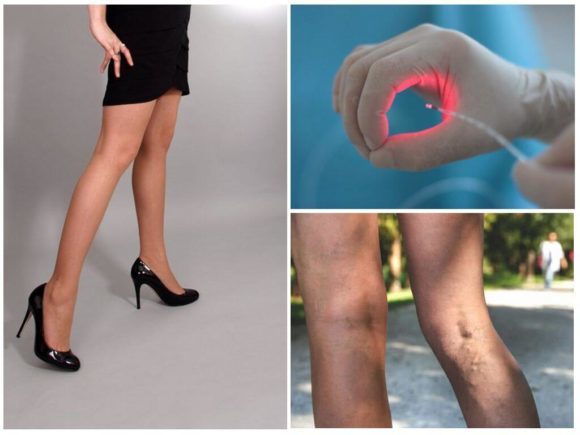 Удаление вен при варикозе на ногах: подготовка, виды, последствия