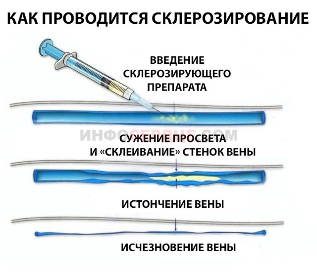 Удаление вен при варикозе на ногах: подготовка, виды, последствия