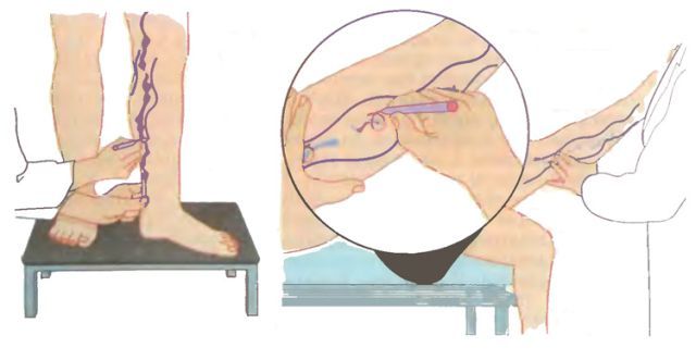 Уколы от варикоза вен на ногах: склеротерапия, трентал, фибро-вейн, инъекции гепарина