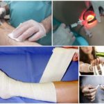 Уколы от варикоза вен на ногах: склеротерапия, трентал, фибро-вейн, инъекции гепарина