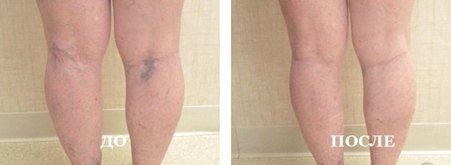 Уколы от варикоза вен на ногах: склеротерапия, трентал, фибро-вейн, инъекции гепарина
