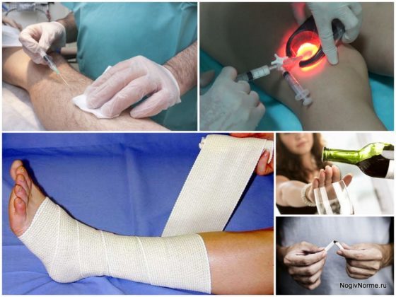 Уколы от варикоза вен на ногах: склеротерапия, трентал, фибро-вейн, инъекции гепарина