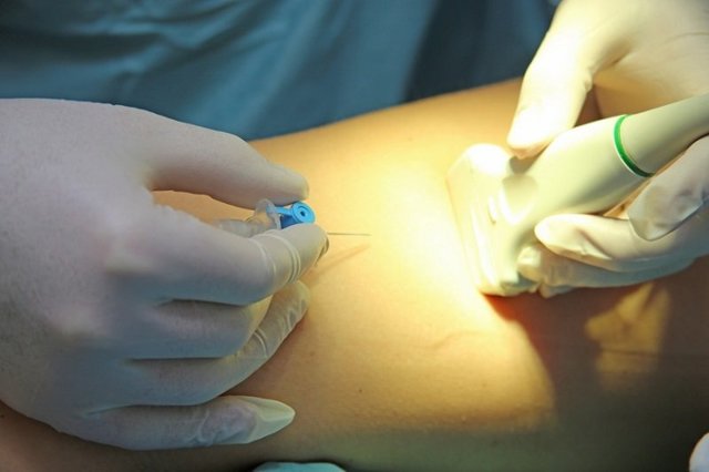 Уколы от варикоза вен на ногах: склеротерапия, трентал, фибро-вейн, инъекции гепарина