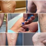 Уколы от варикоза вен на ногах: склеротерапия, трентал, фибро-вейн, инъекции гепарина