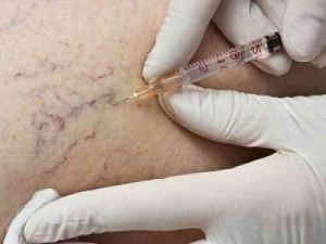 Уколы от варикоза вен на ногах: склеротерапия, трентал, фибро-вейн, инъекции гепарина