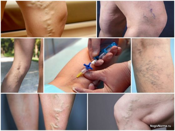 Уколы от варикоза вен на ногах: склеротерапия, трентал, фибро-вейн, инъекции гепарина
