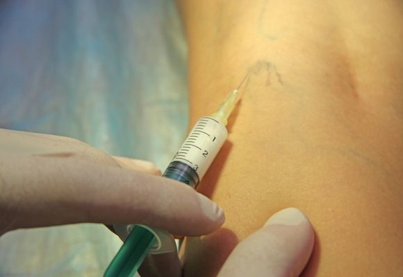 Уколы от варикоза вен на ногах: склеротерапия, трентал, фибро-вейн, инъекции гепарина