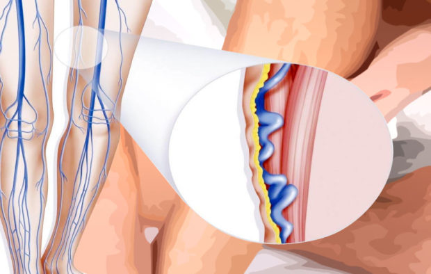 Упражнения при варикозе нижних конечностей: гимнастика, зарядка на работе, лечебная физкультура (лфк)