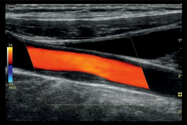 Узи сосудов и вен нижних конечностей: показания и противопоказания, подготовка, как проходит процедура, расшифровка результатов