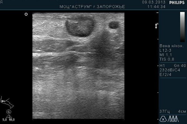 Узи сосудов и вен нижних конечностей: показания и противопоказания, подготовка, как проходит процедура, расшифровка результатов