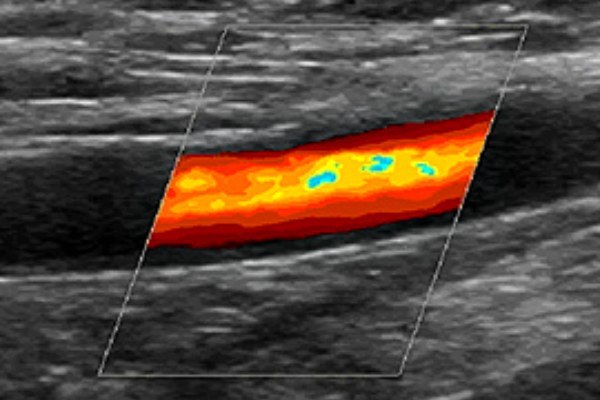 Узи сосудов и вен нижних конечностей: показания и противопоказания, подготовка, как проходит процедура, расшифровка результатов