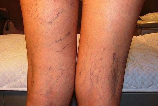 Узи сосудов и вен нижних конечностей: показания и противопоказания, подготовка, как проходит процедура, расшифровка результатов