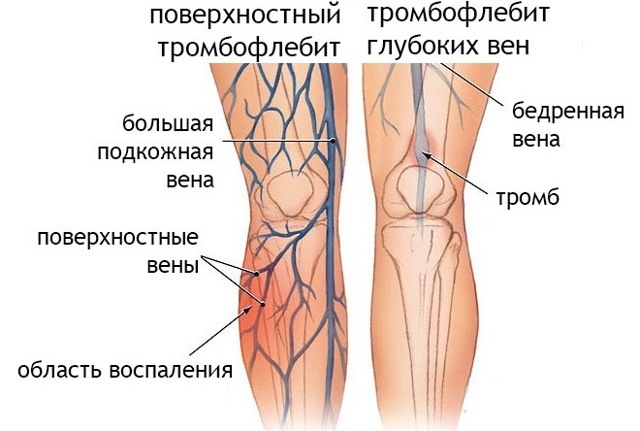 Узи сосудов и вен нижних конечностей: показания и противопоказания, подготовка, как проходит процедура, расшифровка результатов