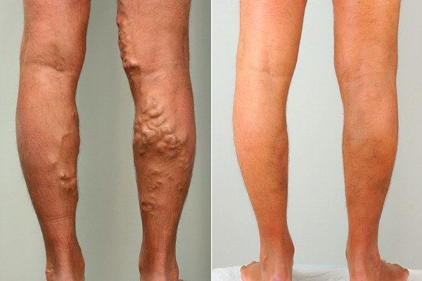 Узи сосудов и вен нижних конечностей: показания и противопоказания, подготовка, как проходит процедура, расшифровка результатов