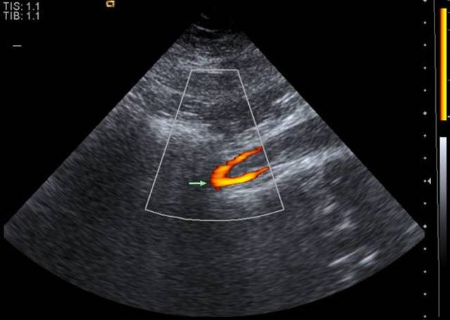 Узи сосудов и вен нижних конечностей: показания и противопоказания, подготовка, как проходит процедура, расшифровка результатов