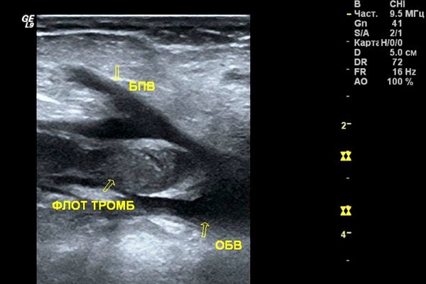 Узи сосудов и вен нижних конечностей: показания и противопоказания, подготовка, как проходит процедура, расшифровка результатов