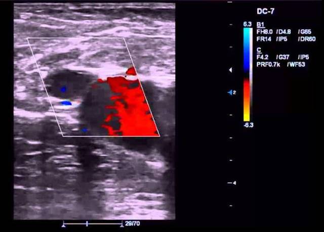Узи сосудов и вен нижних конечностей: показания и противопоказания, подготовка, как проходит процедура, расшифровка результатов