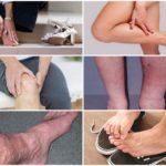 Варикобустер при варикозе – инструкция по применению, отзывы, аналоги, форма выпуска, побочные действия, противопоказания, цена