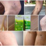 Варикобустер при варикозе – инструкция по применению, отзывы, аналоги, форма выпуска, побочные действия, противопоказания, цена