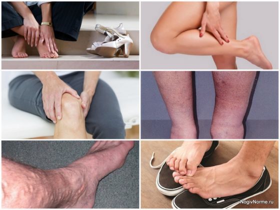 Варикобустер при варикозе – инструкция по применению, отзывы, аналоги, форма выпуска, побочные действия, противопоказания, цена