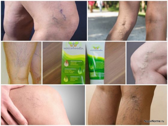 Варикобустер при варикозе – инструкция по применению, отзывы, аналоги, форма выпуска, побочные действия, противопоказания, цена