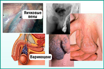 Варикоцеле 1 степени: что такое, сиптомы, причины, нужна и операция