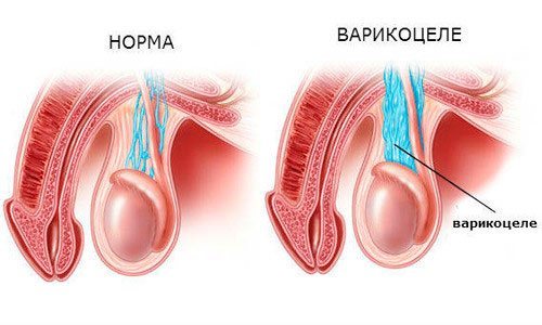 Варикоцеле 1 степени: что такое, сиптомы, причины, нужна и операция