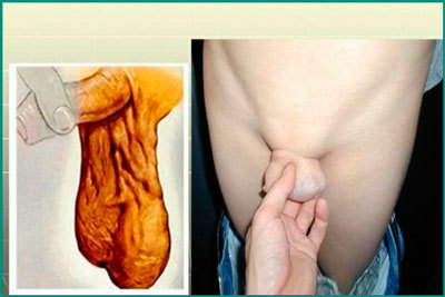 Варикоцеле 1 степени: что такое, сиптомы, причины, нужна и операция