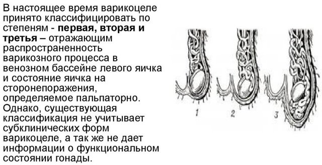 Варикоцеле 1 степени: что такое, сиптомы, причины, нужна и операция