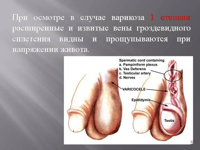 Варикоцеле 1 степени: что такое, сиптомы, причины, нужна и операция