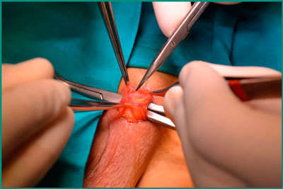 Варикоцеле 1 степени: что такое, сиптомы, причины, нужна и операция