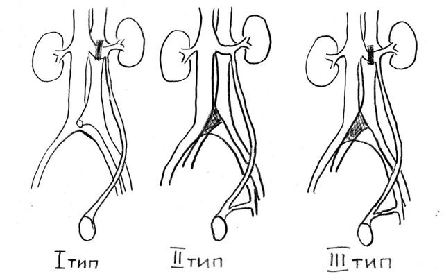 Варикоцеле 1 степени: что такое, сиптомы, причины, нужна и операция