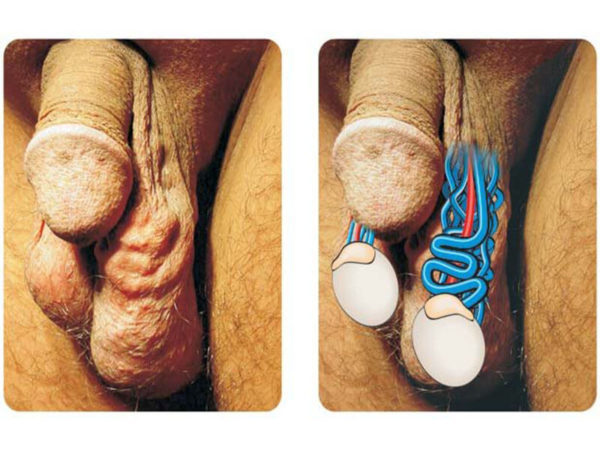 Варикоцеле 2 степени: симптомы, причины, оперативное лечение (осложнения), лечение без операции (медикаменты, народное), профилактика, последствия